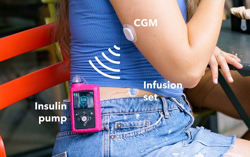How CGM works with insulin pump
