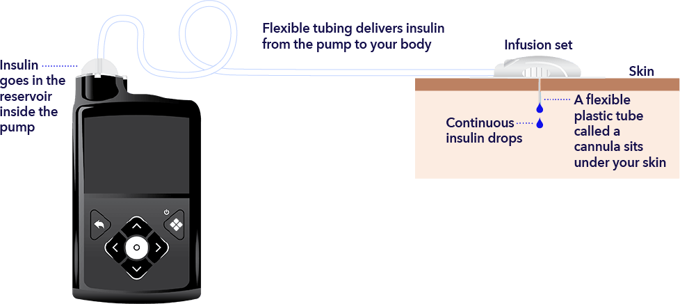 How does an insulin pump work?