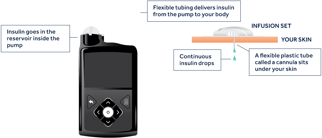 How does an insulin pump work?